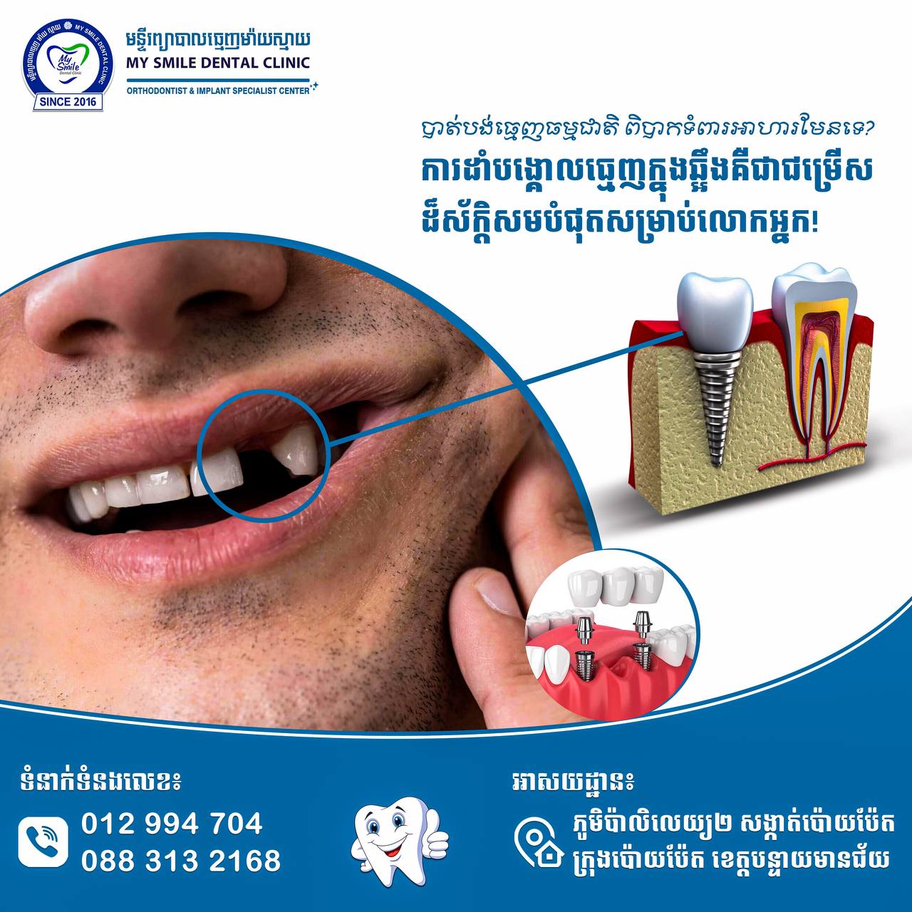 ដាំបង្គោលធ្មេញ-ជំនួសធ្មេញ-បង្កើតស្នាមញញឹម, dental-implant-tooth-replacement-confidence